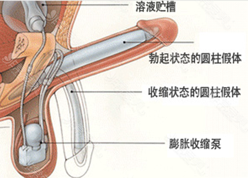 韩国阴茎整形手术科普贴，这种方式在韩国本地很普遍