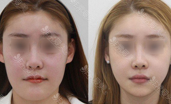 韩国一路美整形外科下巴轮廓改善图