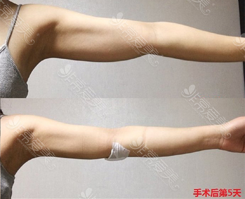 韩国TL整形医院手臂吸脂案例图