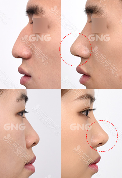 男性隆鼻与女性隆鼻鼻尖区别