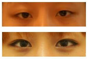 韩国ARUMP LINE整形外科双眼皮手术对比图