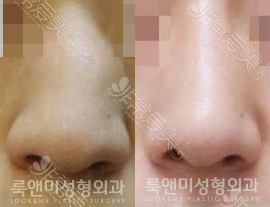 韩国遇见美整形医院鼻整形图