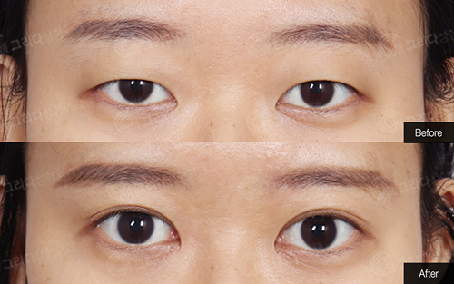 韩国GRIDA整形外科双眼皮案例