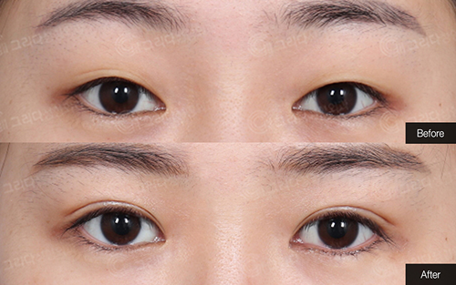 韩国GRIDA整形外科眼部整形案例