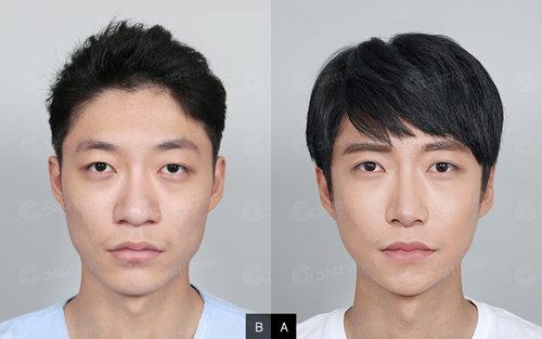 韩国GRIDA整形外科鼻部整形案例