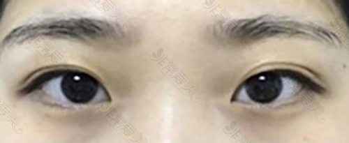 韩国GRIDA整形外科双眼皮手术前