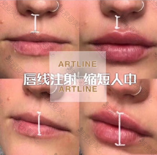 韩国artline整形外科唇线注射缩短人中