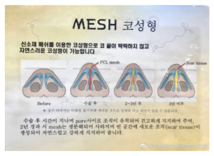 韩国mesh隆鼻材料怎么样？mesh隆鼻手术后会引发感染吗？