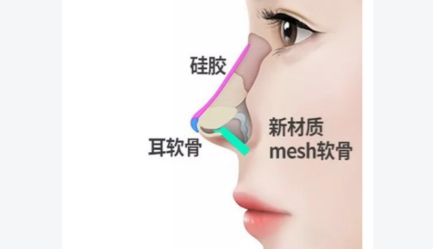 mesh材料适合植入鼻部哪个部位