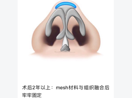 mesh材料植入鼻部稳固吗