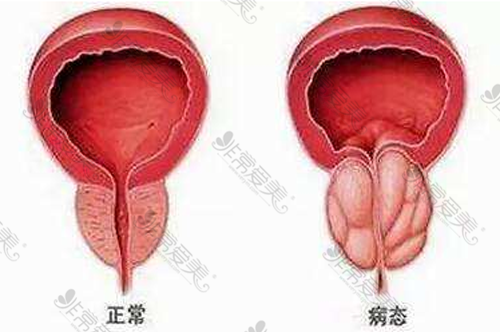 正常前列腺与肥大前列腺对比