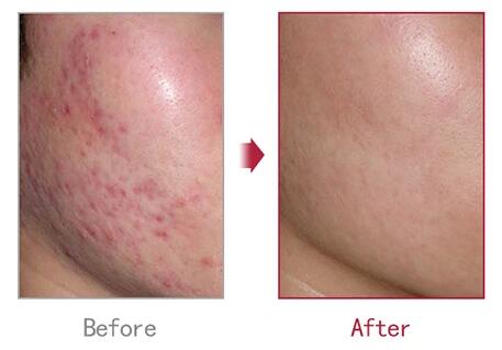 Beautyclassic皮肤科痤疮皮肤痘坑痘印治疗对比图
