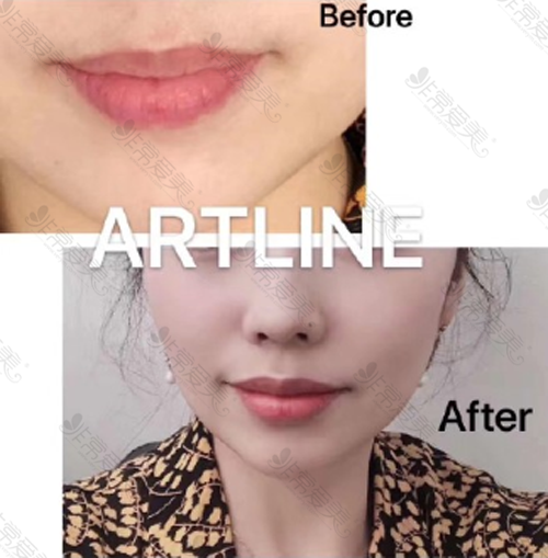 artline医院唇部整形案例