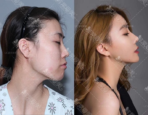 韩国uc突嘴手术前后对比图