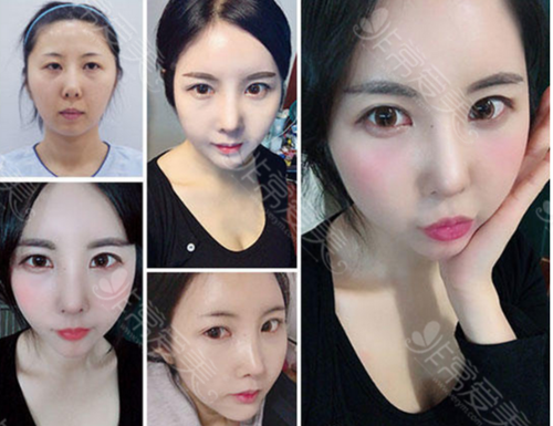 韩国自体脂肪填充面部后导致脸部下垂，是填充过量了吗？