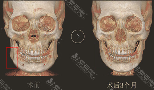 下颌角手术3D-CT正面