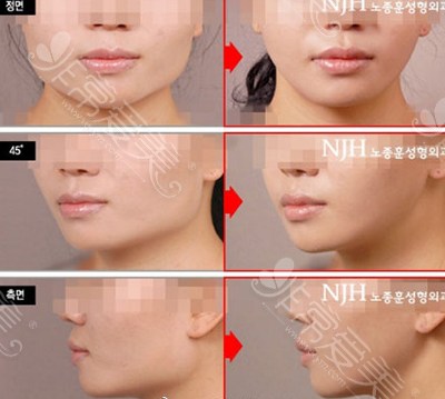 韩国NJH整形外科面部轮廓效果对比图