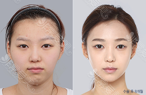 韩国DA整形外科面部轮廓案例