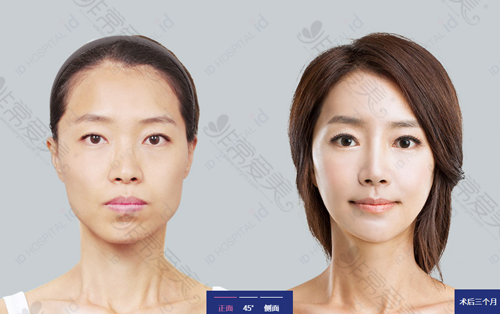 韩国ID医院突嘴手术前后对比