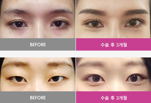 韩国migo整形外科双眼皮手术