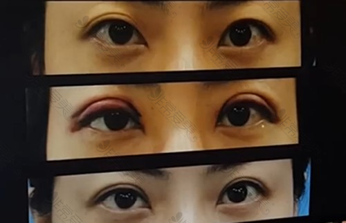 韩国iwant整形双眼皮失败修复少钱？韩国双眼皮修复医院推荐