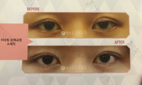 韩国i want整形外科双眼皮修复对比