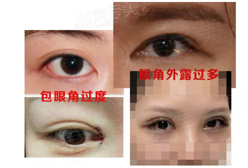 韩国GIO整形眼角疤痕修复