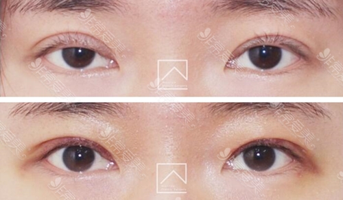 韩国Misoline整形医院针对双眼皮失败修复有哪些特色？