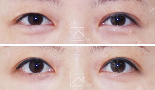 韩国Misoline整形自然款双眼皮修复图片