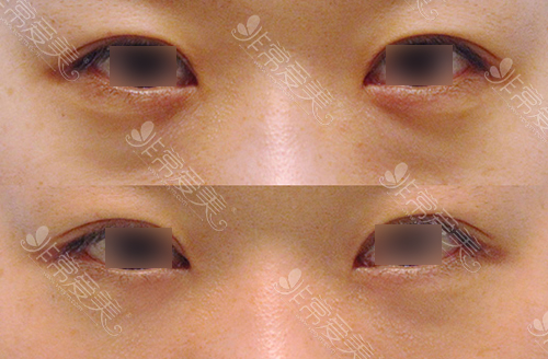 韩国ST整形外科医院眼底脂肪重排图