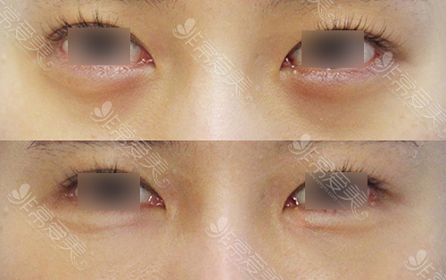 韩国ST整形外科医院眼底脂肪重排对比