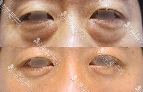 韩国ST整形外科医院眼底脂肪重排改善眼袋图