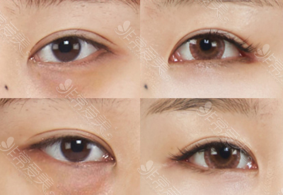 眼底脂肪重排能改善黑眼圈眼袋