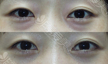 韩国BK眼部脂肪重组案例图