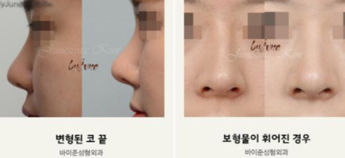 韩国byjune整形外科鼻部矫正案例