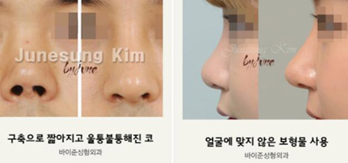 韩国byjune整形外科鼻部整形案例图
