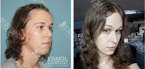 小编前期已介绍过↓ 《泰国kamol咖蒙整形医院能做变性手术吗?