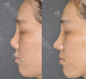 韩国will整形外科鼻修复