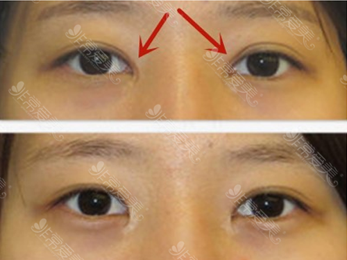 韩国双眼皮疤痕修复专家盘点，2023年这几个医生难预约！