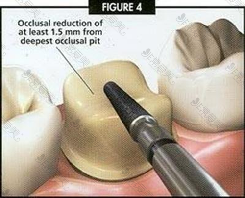牙体预备过程展示