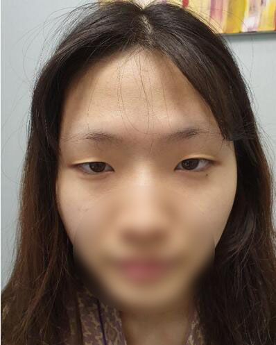 韩国歌娜整形外科双眼皮整形日记