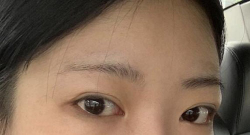 韩国歌娜整形外科双眼皮修复术前