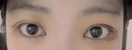 韩国歌娜整形外科眼修复整形怎么样