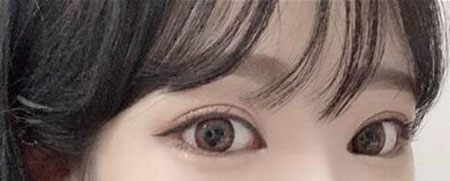 韩国歌娜整形外科眼修复术后效果