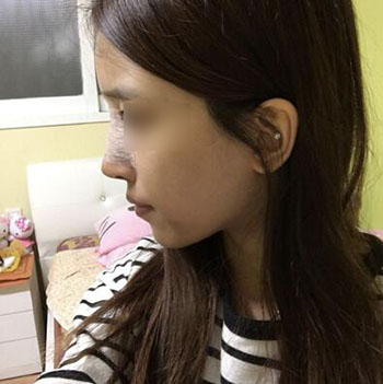 韩国歌娜整形外科鼻翼缩小恢复期照片