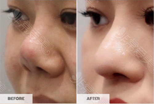 韩国light医院鼻修复手术对比图