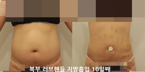 韩国CL整形医院腰腹吸脂案例