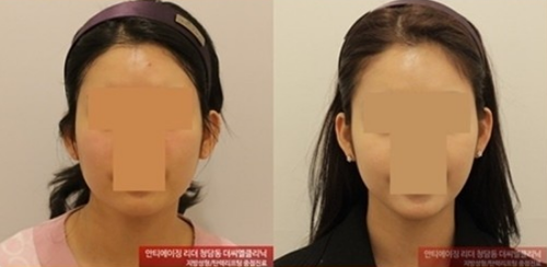 韩国CL整形医院面部吸脂案例
