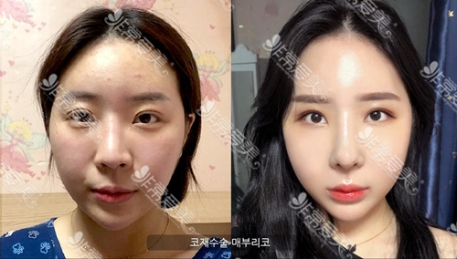 韩国iron眼鼻手术一般多少钱