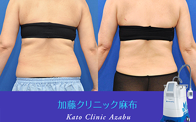 日本加藤整形医院腰腹吸脂背后对比